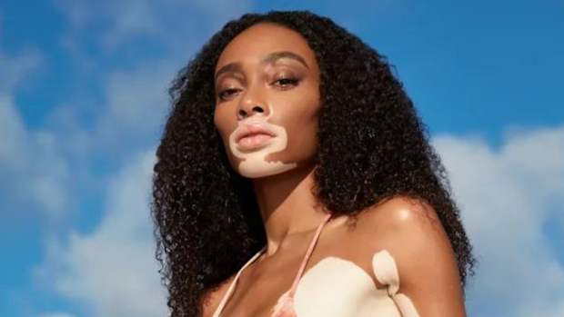 Winnie Harlow